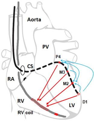 Capture threshold of bipolar and unipolar pacing of left ventricle via coronary sinus branch: longitudinal study